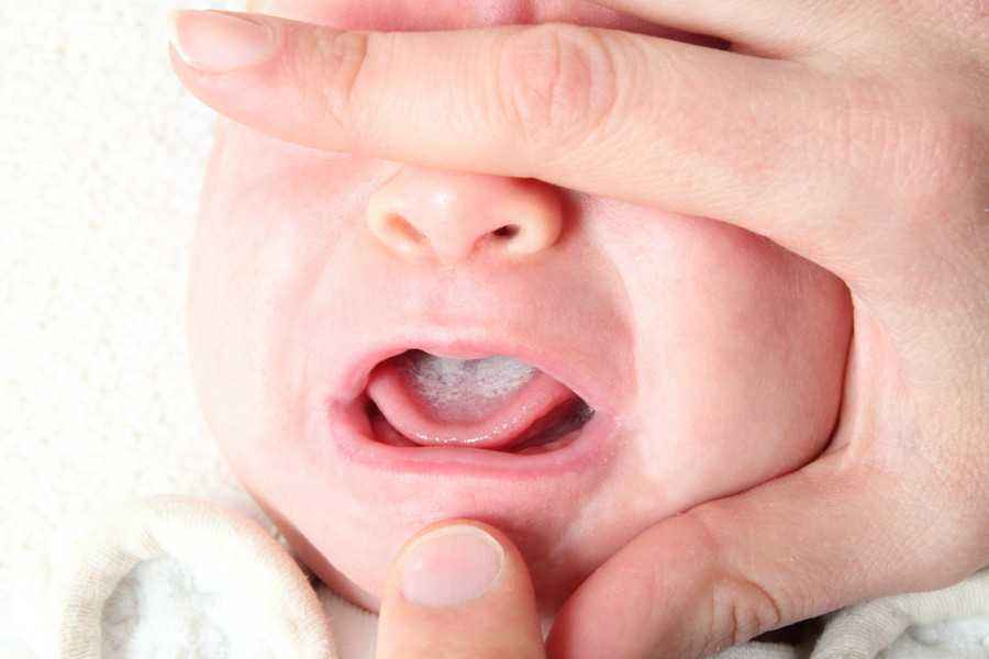 Cara Membersihkan Lidah Bayi Dengan Benar